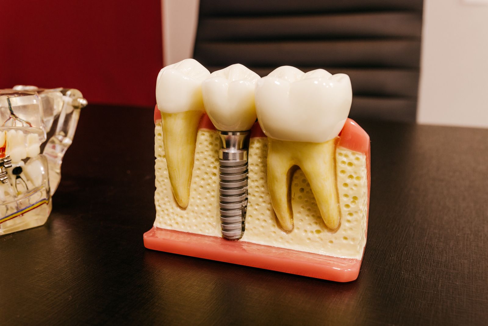 A teaching model of a dental implant and crown between two natural teeth